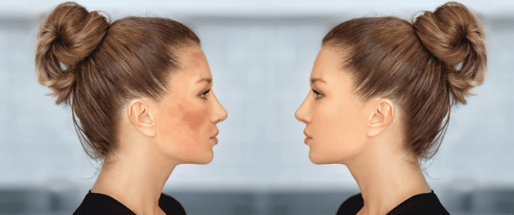 A side-by-side comparison of uneven and even skin tone.