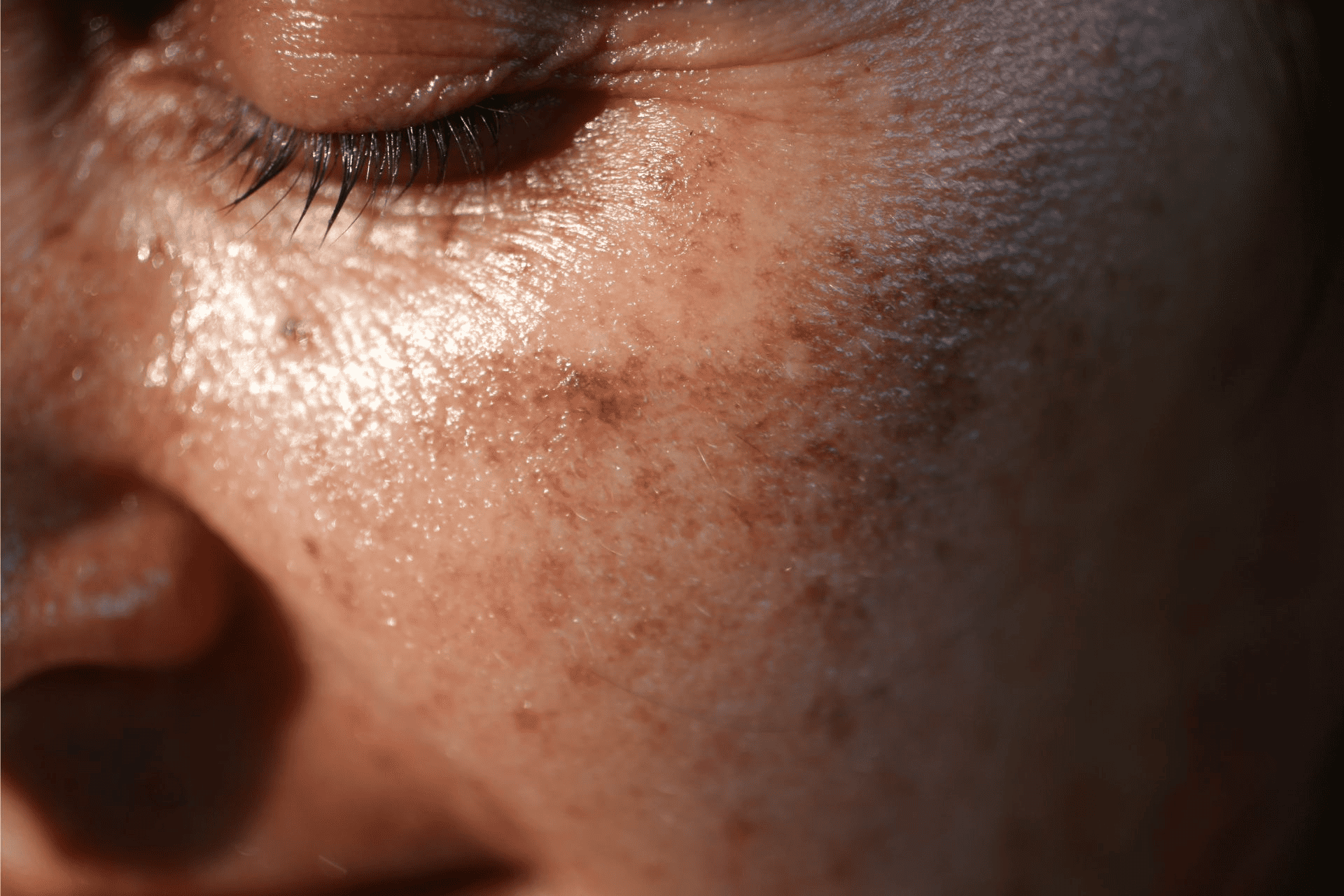  A close-up photo of a person with sunspots. 