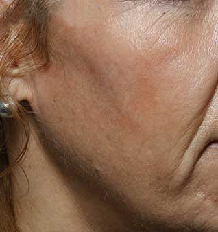 Cheek and Lip Enhancement - Before