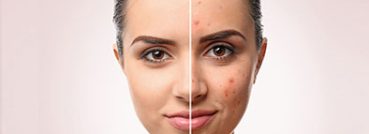 Acne Scars, Conditions - APT Medical Aesthetics