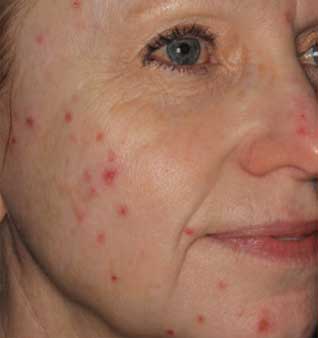 Acne Scars Treatment - Before