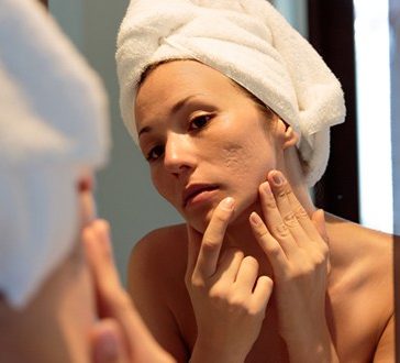 Acne & Blemish Treatment Oakville