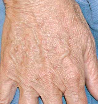 Anti-Aging Hand Treatments - After