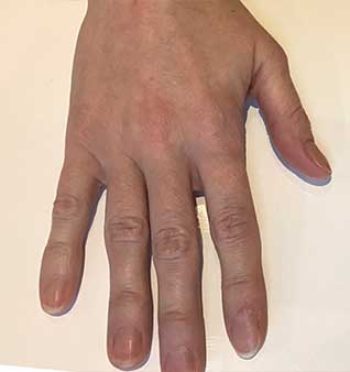 Anti-Aging Hand Treatments - After