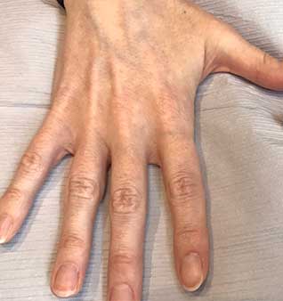 Anti-Aging Hand Treatments -Before