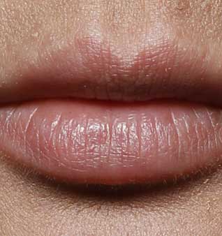 Cheek and Lip Enhancement - After