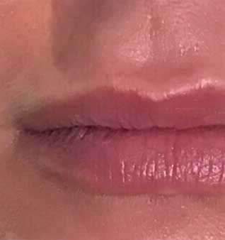 Juvederm® - Before