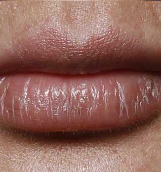 Cheek and Lip Enhancement - Before