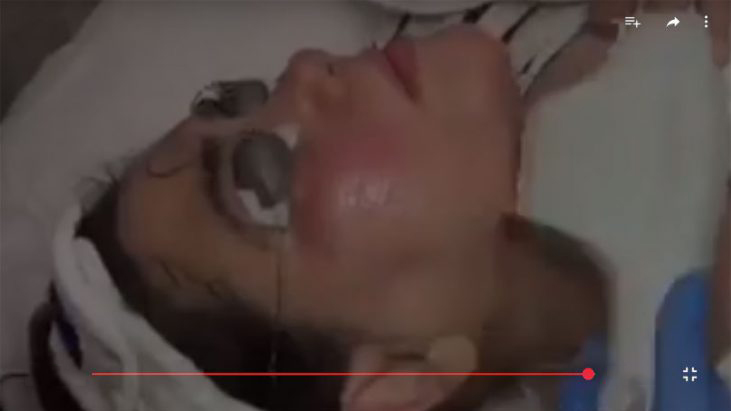 Best Treatment for Skin Laxity - APT Medical Aesthetics youtube thumbnail