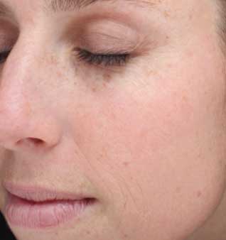 Brown Spots and Sun Damage - After