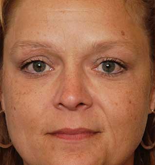Dull Skin Treatment - Before