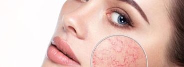 Facial Veins And Capillaries, Conditions - APT Medical Aesthetics