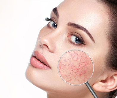 Facial Veins And Capillaries, Conditions - APT Medical Aesthetics