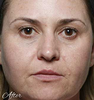 Wrinkles and Fine Lines - After