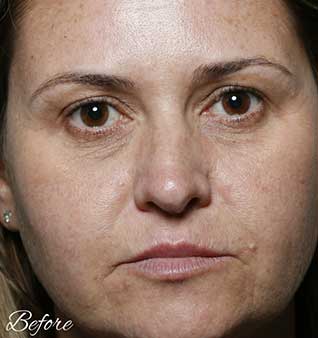 Wrinkles and Fine Lines - before