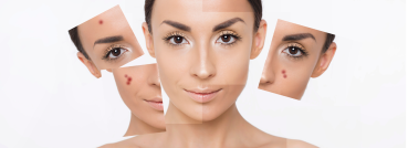 Forever Clear BBL™ Treatment - APT Medical Aesthetics