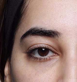 Get Rid of Under Eye Hollows - After