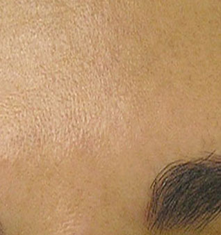 HydraFacial - After