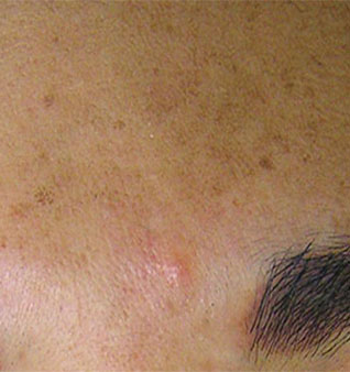HydraFacial - Before