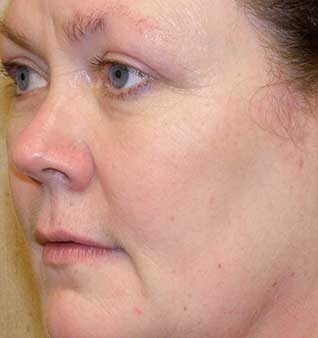 BBL Photofacial - After