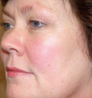 BBL Photofacial - Before