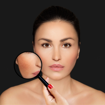 IPL or BBL Photo Facial
