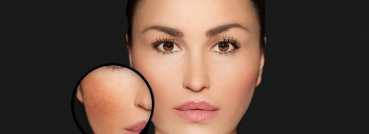 IPL Photo Facial - APT Medical Aesthetics