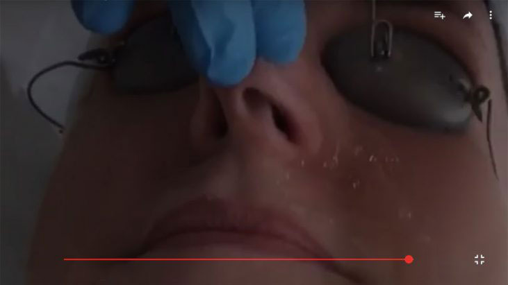 Laser Vein Removal Treatment - APT Medical Aesthetics youtube thumbnail
