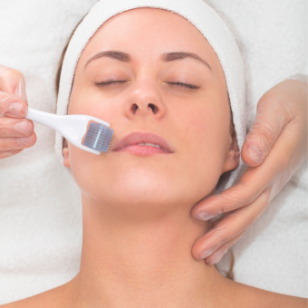 Microneedling