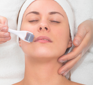 Microneedling Treatment Oakville - APT Medical Aesthetics