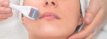Microneedling Treatment Oakville - APT Medical Aesthetics