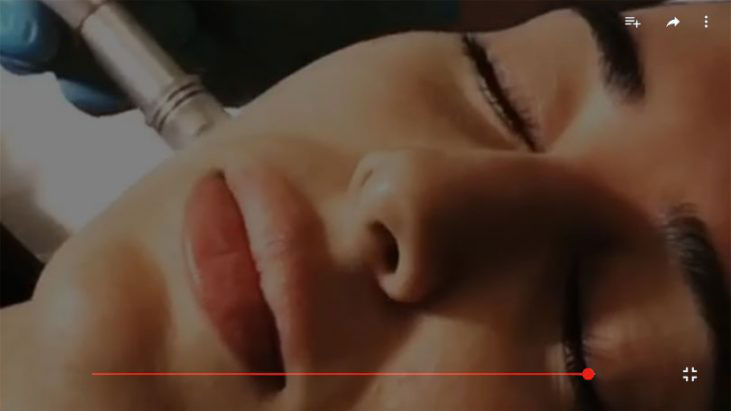 Microneedling Treatment - APT Medical Aesthetics youtube thumbnail
