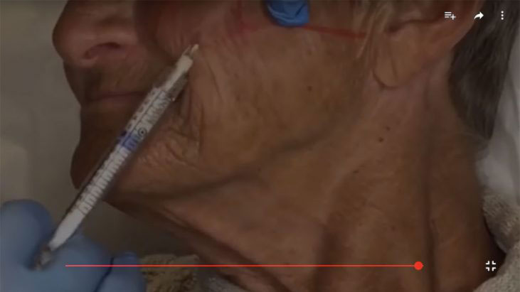 Radiesse Dermal Filler Treatment - APT Medical Aesthetics youtube thumbnail