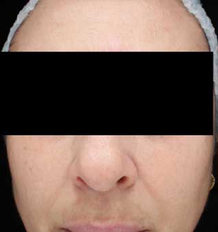 chemical peel - after