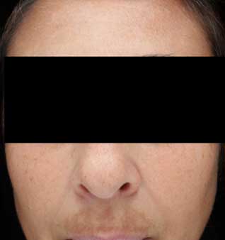 chemical peel - before