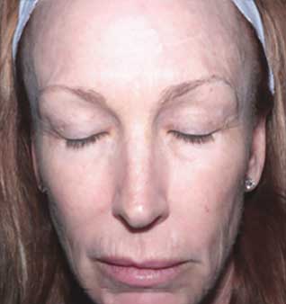 Treat Uneven Skin Texture - After