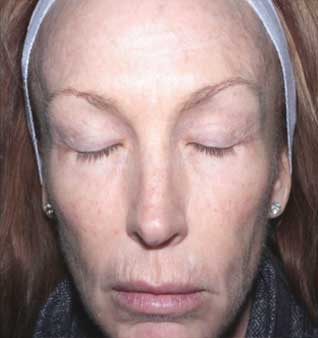 Treat Uneven Skin Texture - Before