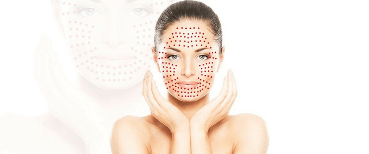 Vampire Facial