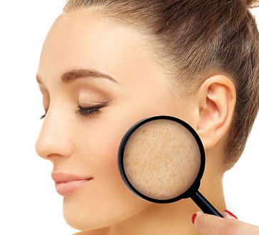 Melasma, Conditions - APT Medical Aesthetics