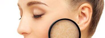 Melasma, Conditions - APT Medical Aesthetics