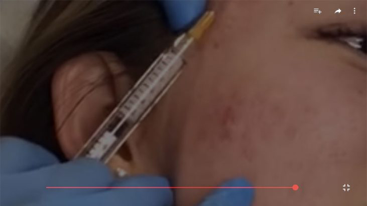 Best Acne Scar Treatment Oakville youtube thumbnail