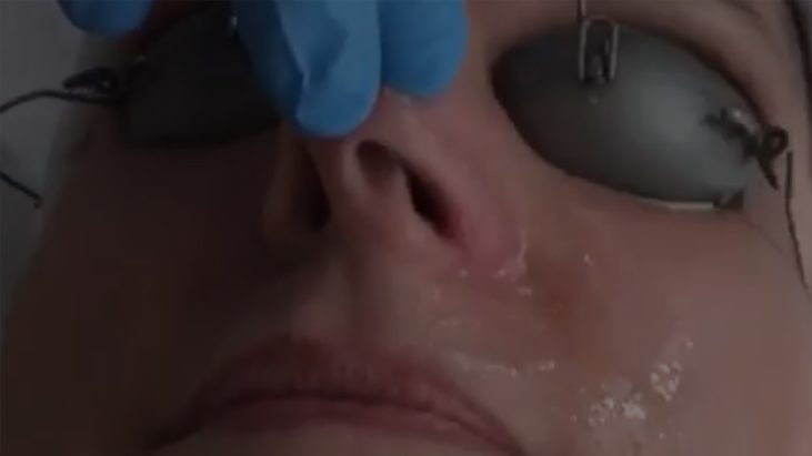 BBL BroadBand Light Skin Treatment - APT Medical Aesthetics youtube thumbnail