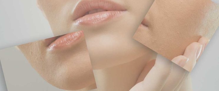 Woman's Face Is Altered with Dermal Fillers By APT Medical Aesthetics