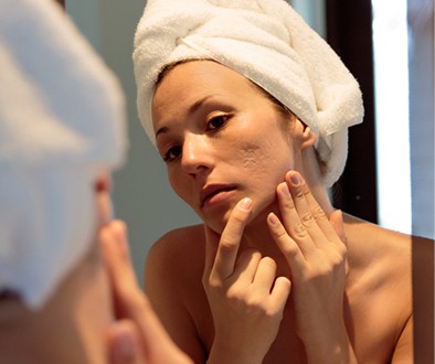 Acne & Blemishes, Conditions - APT Medical Aesthetics