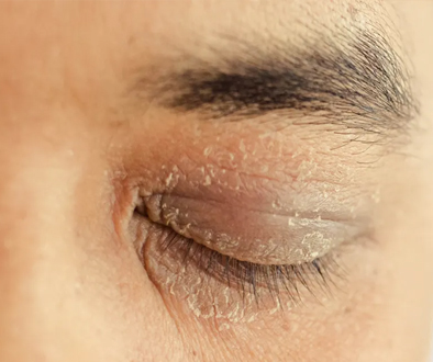 Dry skin around the eyes