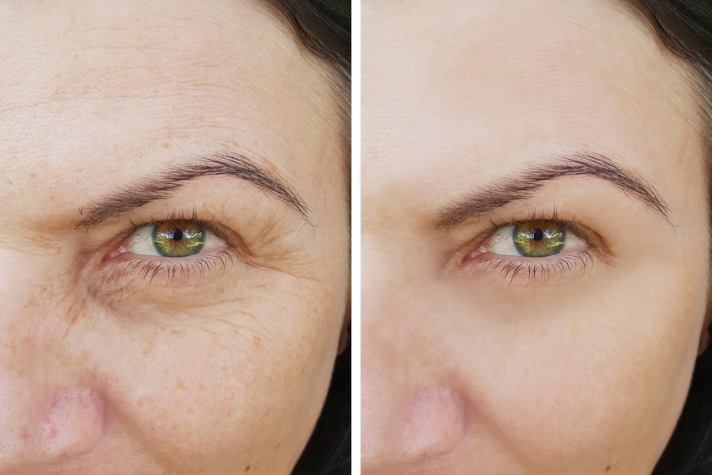  treatments for wrinkles Oakville