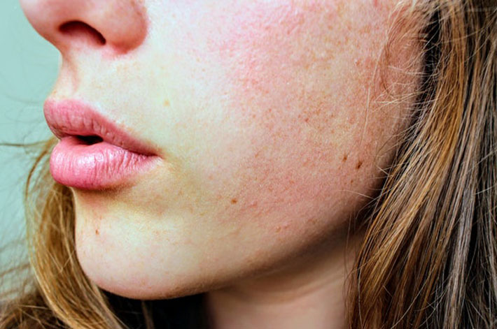Woman with sunburn on cheeks 