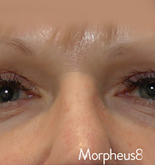 Morpheus8® Treatment - After