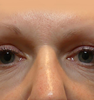 Morpheus8® Treatment - Before