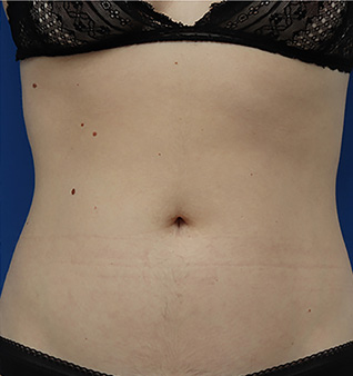 Morpheus8® Treatment - After